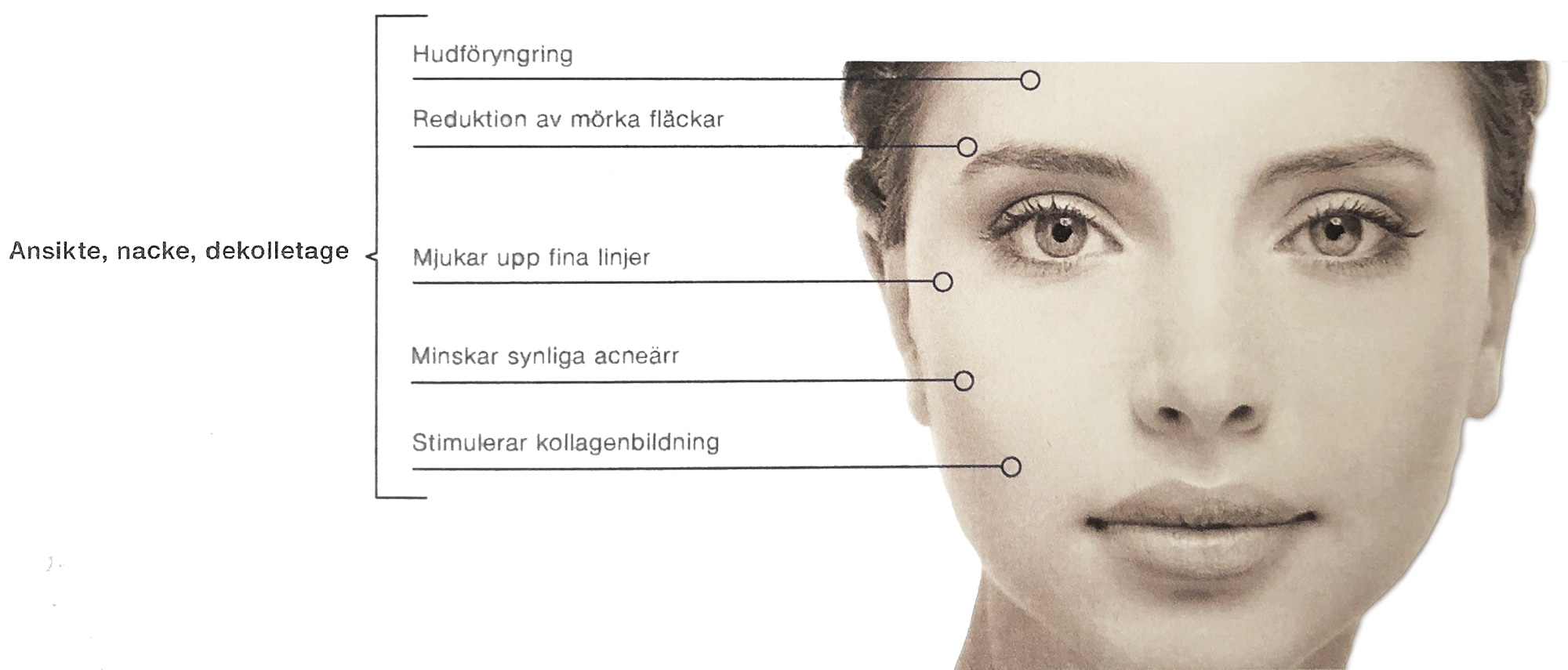 Bild med förklaring av microneedeling proceduren