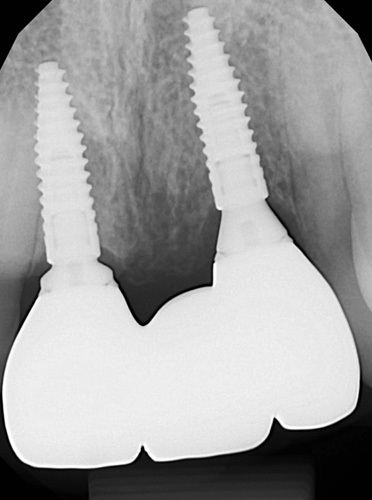 tandinplantat tandinplantat